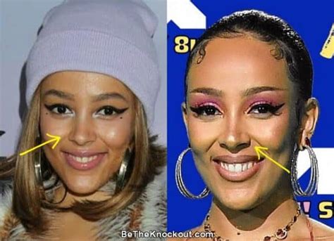 did doja cat get implants|More.